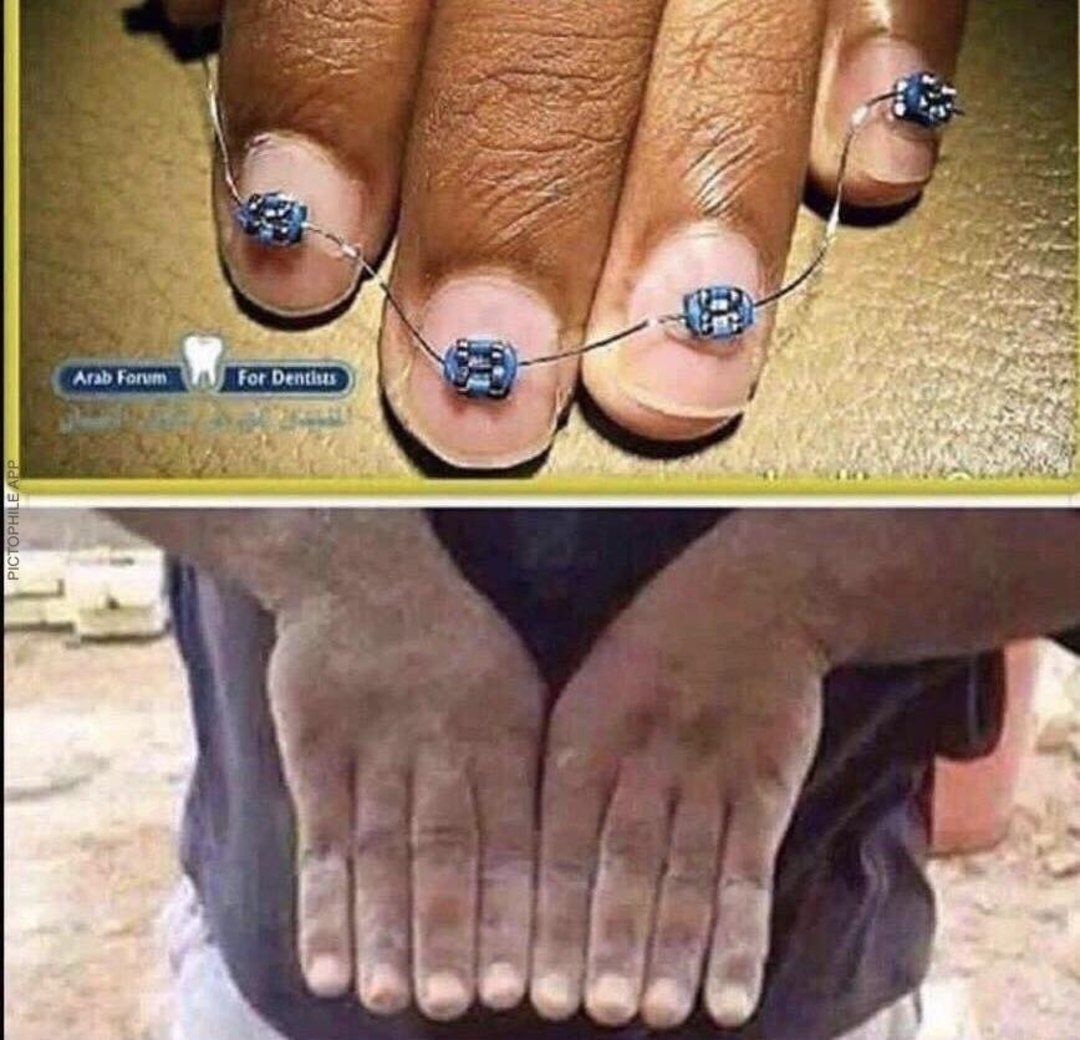 A split image: the top half shows fingernails with dental braces, while the bottom half shows two hands with rough, darkened skin, held together palm-down, mimicking the look of large teeth.