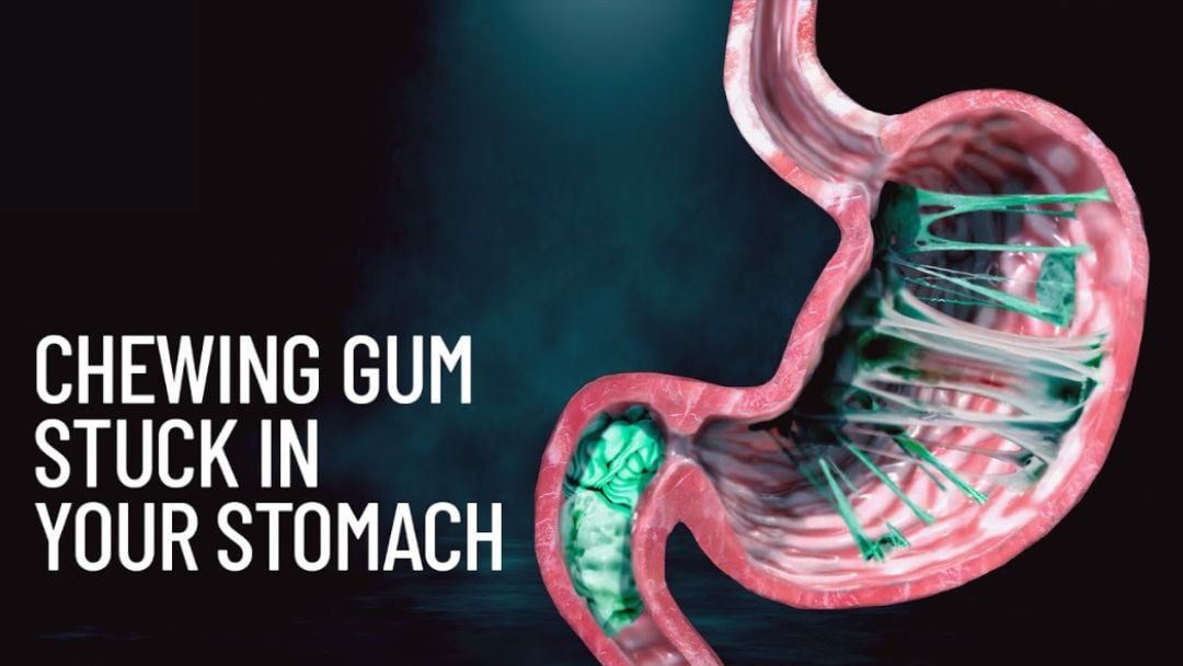 A digital illustration of a stomach with a wad of green chewing gum tangled in white fibers inside, next to bold white text that reads, "CHEWING GUM STUCK IN YOUR STOMACH.