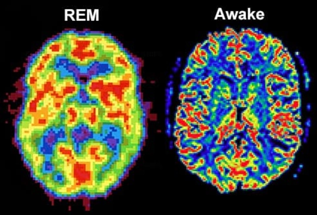Two brain scans side by side: the left labeled "REM" shows more red and yellow areas, while the right labeled "Awake" shows more blue and green areas, indicating different brain activity patterns.