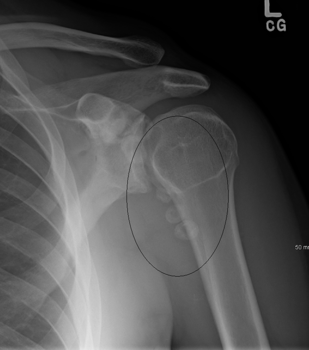 X-ray of a left shoulder and upper arm showing a fracture in the upper humerus, highlighted by a black oval. Bone displacement is visible at the shoulder joint.