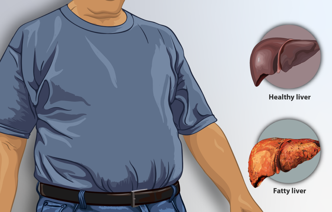 Illustration of an overweight person in a blue shirt, with side-by-side diagrams of a healthy liver and a fatty liver shown for comparison on the right side.