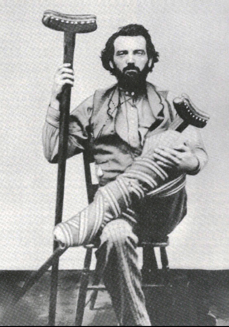 A man with a beard sits on a wooden chair, holding two crutches. His left leg is heavily bandaged and propped up across his lap. The image is in black and white.