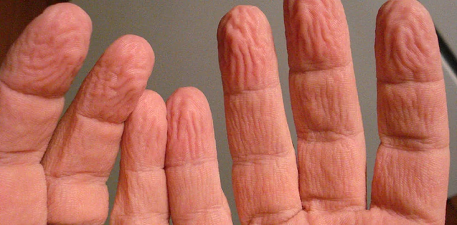 A close-up of a hand with wrinkled, pruney skin on the fingers, often caused by prolonged exposure to water. The background is blurred and neutral in color.