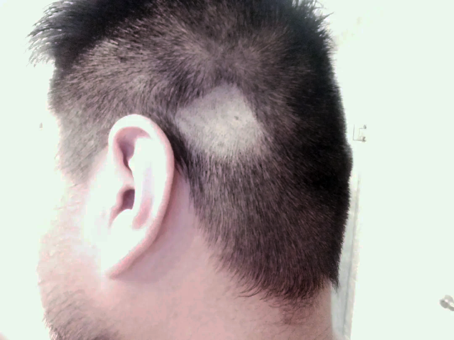 A close-up of the side of a person's head shows short dark hair with a visible bald patch near the top, above the ear. The ear and part of the neck are also visible.