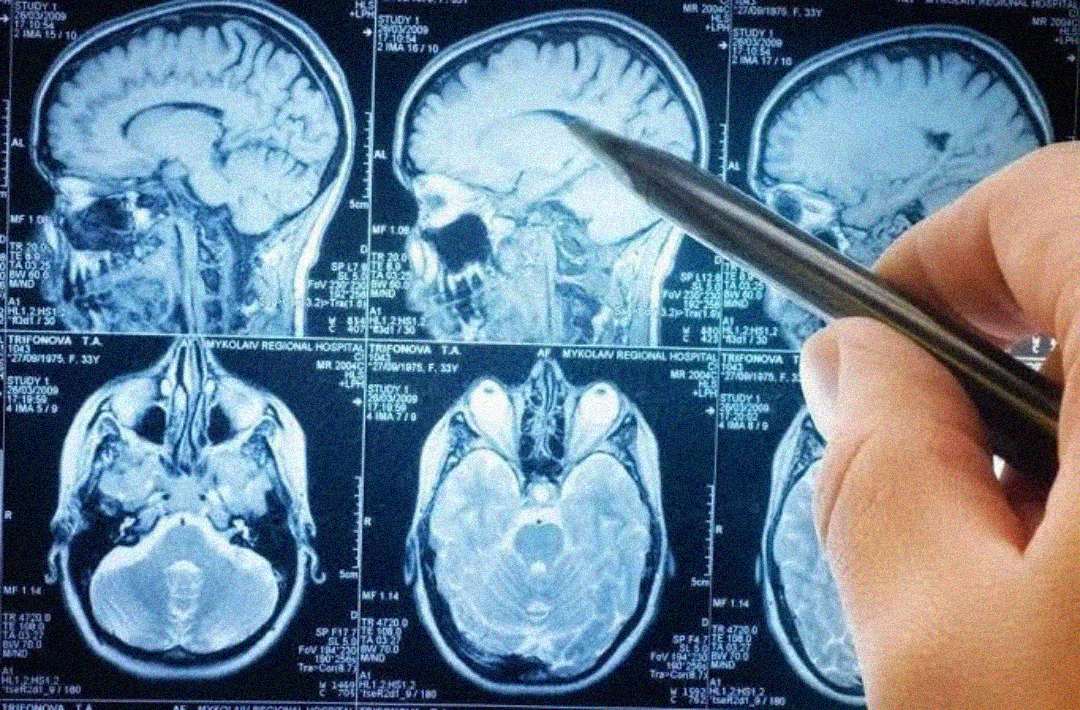 A hand holding a pen points to a section of a brain scan displayed on a screen, showing multiple MRI images of the human brain from different angles.