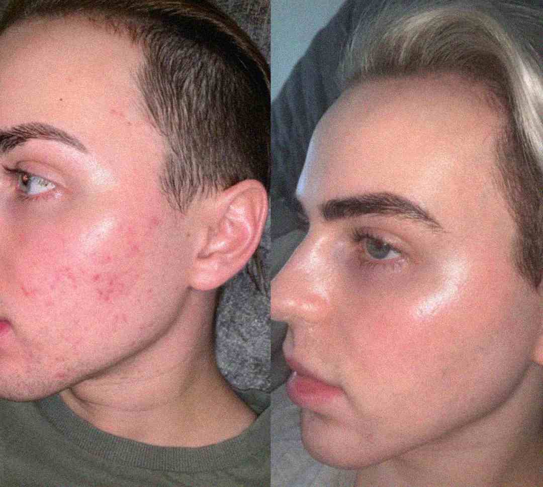 Side-by-side photos show the same person's face. The left image shows noticeable acne and redness on the cheek, while the right image shows clear, smooth skin, highlighting an improvement in complexion.