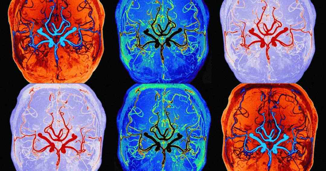 Six colored MRI brain scans show blood vessels in bright red, blue, and green tones against orange and blue backgrounds, arranged in two rows of three, resembling a pop art pattern.