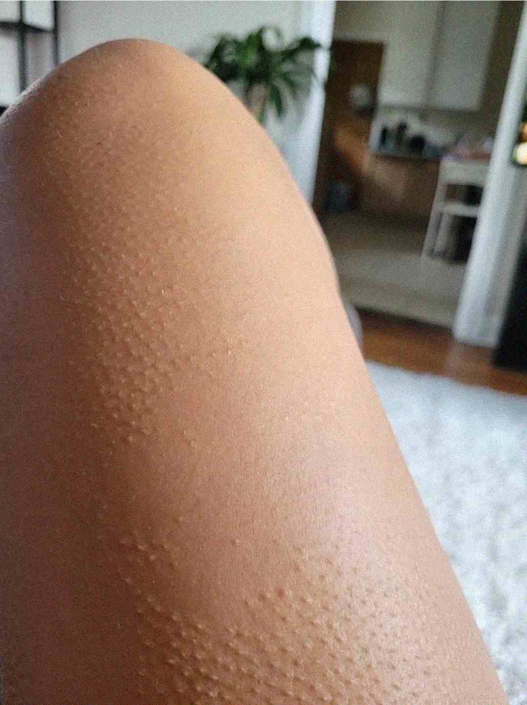 A close-up of a person's leg with noticeable goosebumps, indoors with a blurred background showing a plant and furniture.