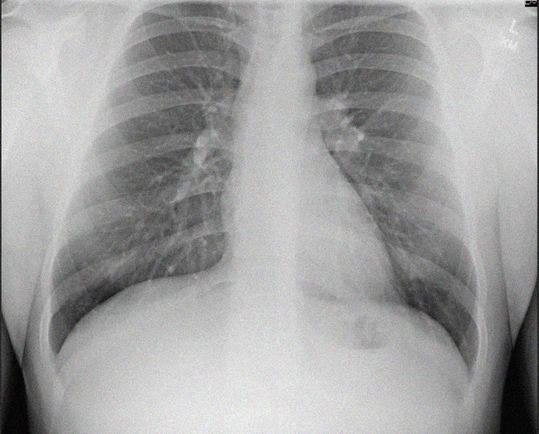 Chest X-ray showing the lungs, ribs, heart, and diaphragm. Both lungs appear clear, and the bones and heart silhouette are visible in a standard frontal view.