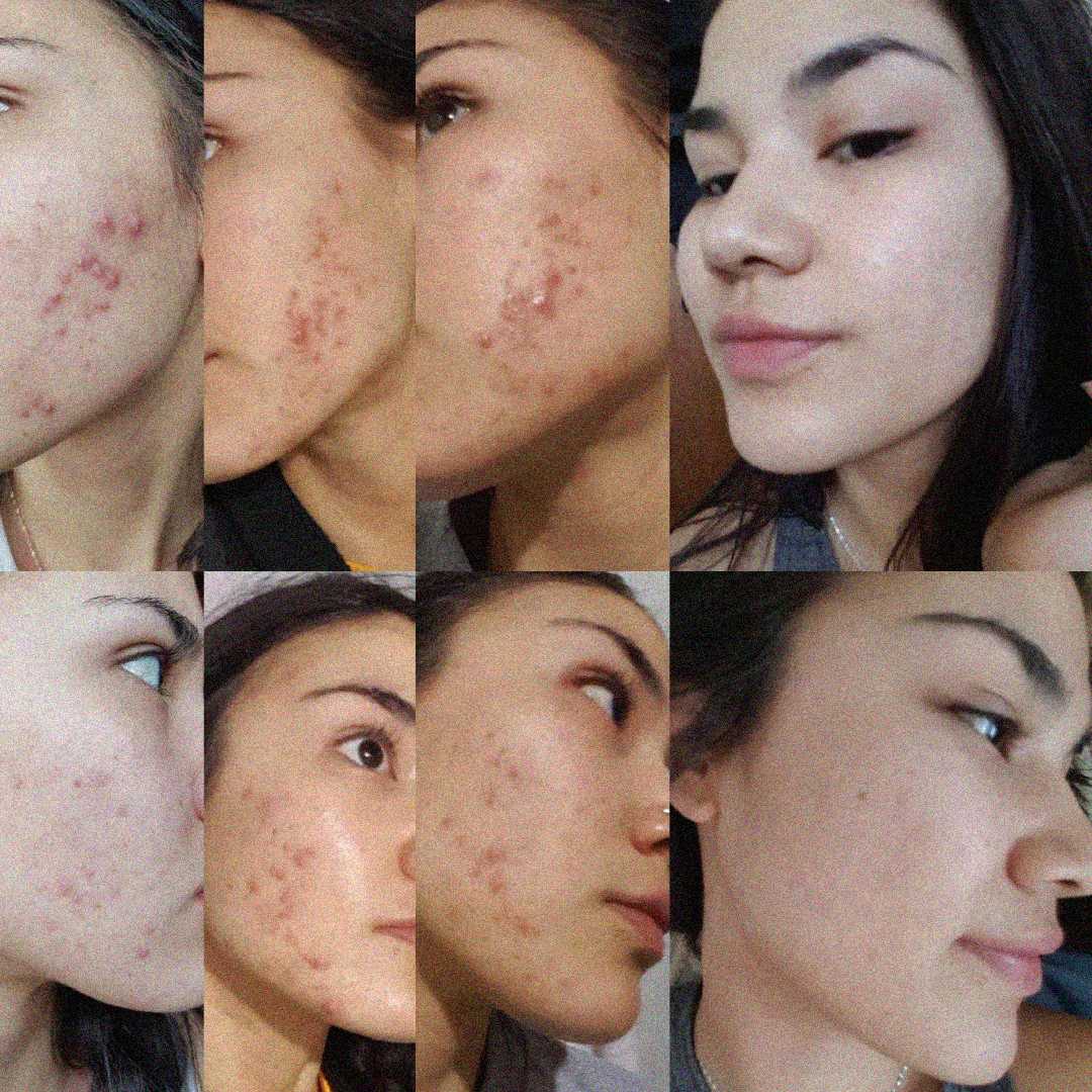 A collage of eight photos showing the same woman’s face at different stages of acne treatment, progressing from severe acne and redness to clear, smooth skin with minimal blemishes.
