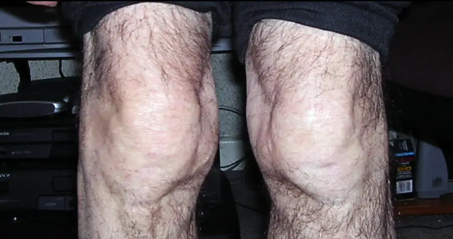 Two swollen, hairy knees with visible lumps, possibly indicating inflammation or a medical condition. The person is seated indoors, and the background includes electronic equipment.