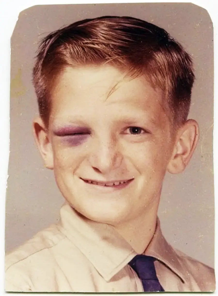 A school-age boy with light hair and a slight smile poses for a portrait. He has a noticeable black eye on his left side but appears cheerful, wearing a tan shirt and a dark tie.