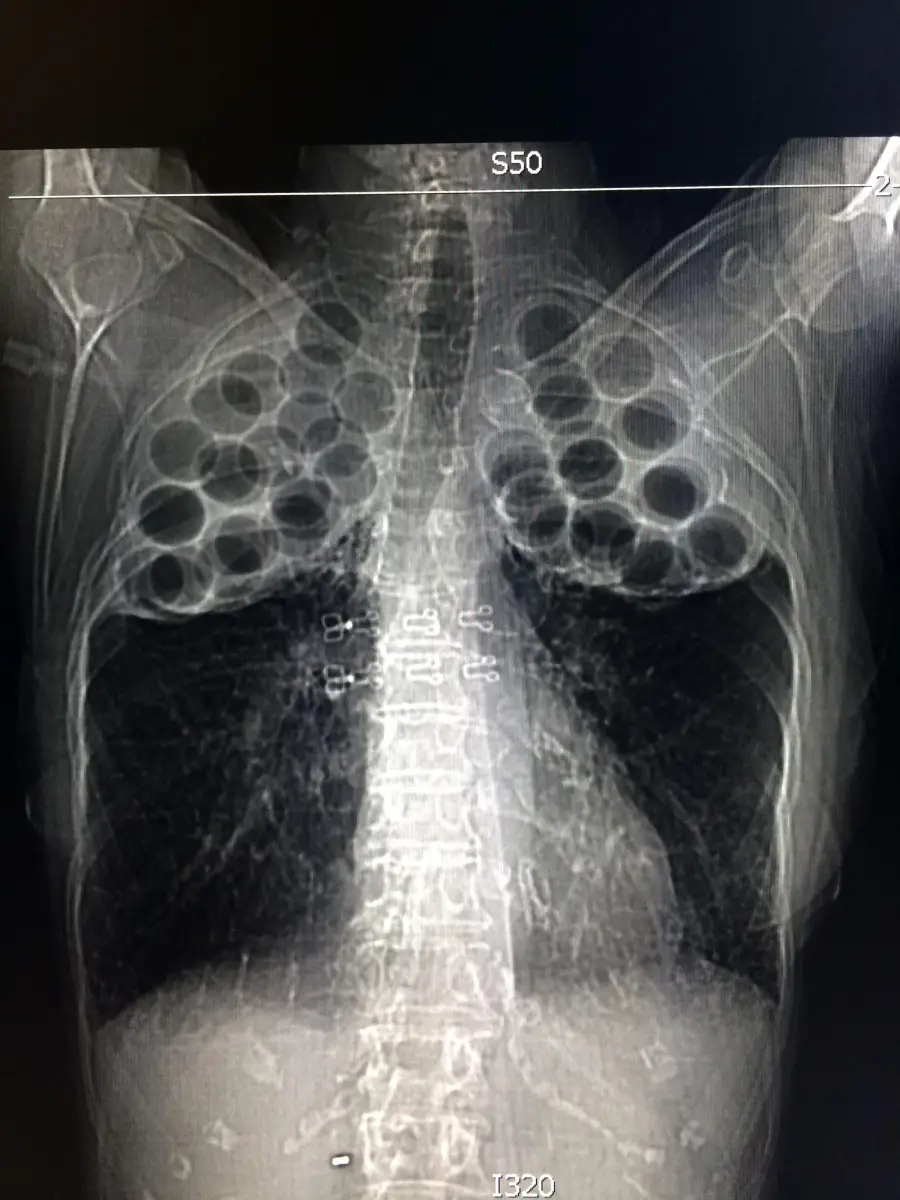 Chest X-ray showing multiple round foreign objects clustered in the upper chest area above the lungs, with the spine and ribs clearly visible.
