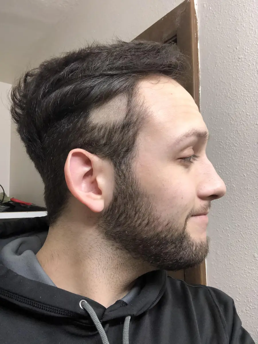 A man with brown hair and a beard is shown in profile. There is a large patch of hair missing on the side of his head above the ear, revealing scalp. He is wearing a dark hoodie and standing indoors.
