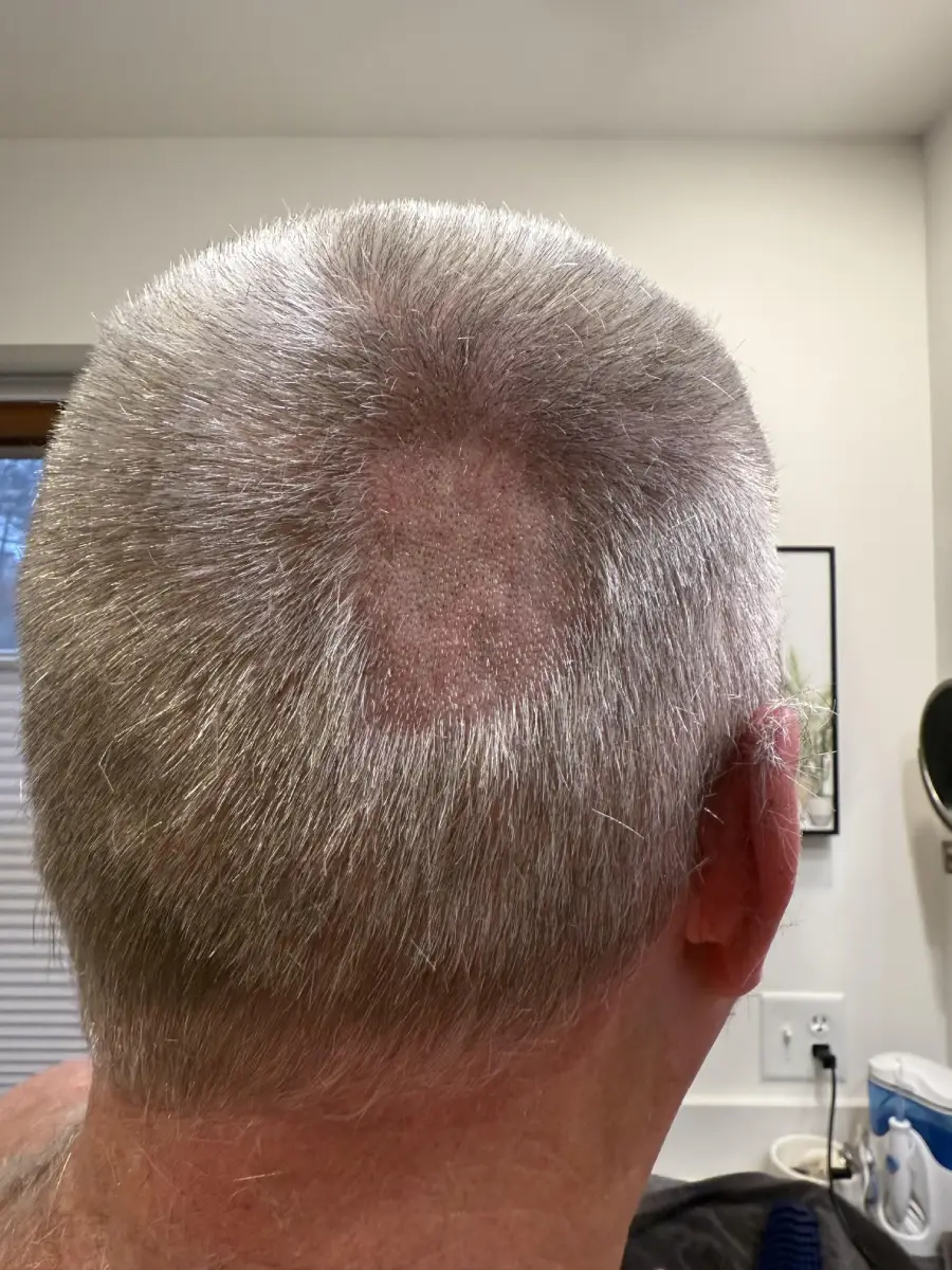 The back of a person’s head with short gray hair and a noticeable circular patch of scalp where the hair is missing.
