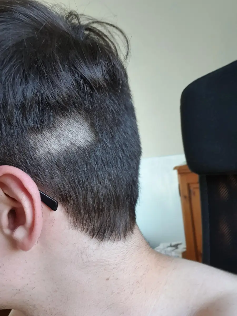 Close-up of a person’s head showing a patch of hair missing near the ear, revealing the scalp. The person appears to be sitting in a chair with a black mesh backrest.