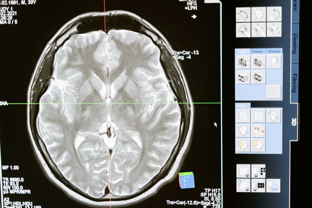 MRI brain scan in grayscale shown on a monitor, with brain structures visible.